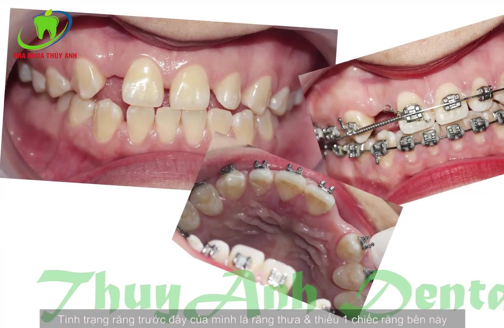 NIỀNG RĂNG - TRỒNG IMPLANT  - DÁN SỨ VENEER  -  3 TRONG 1