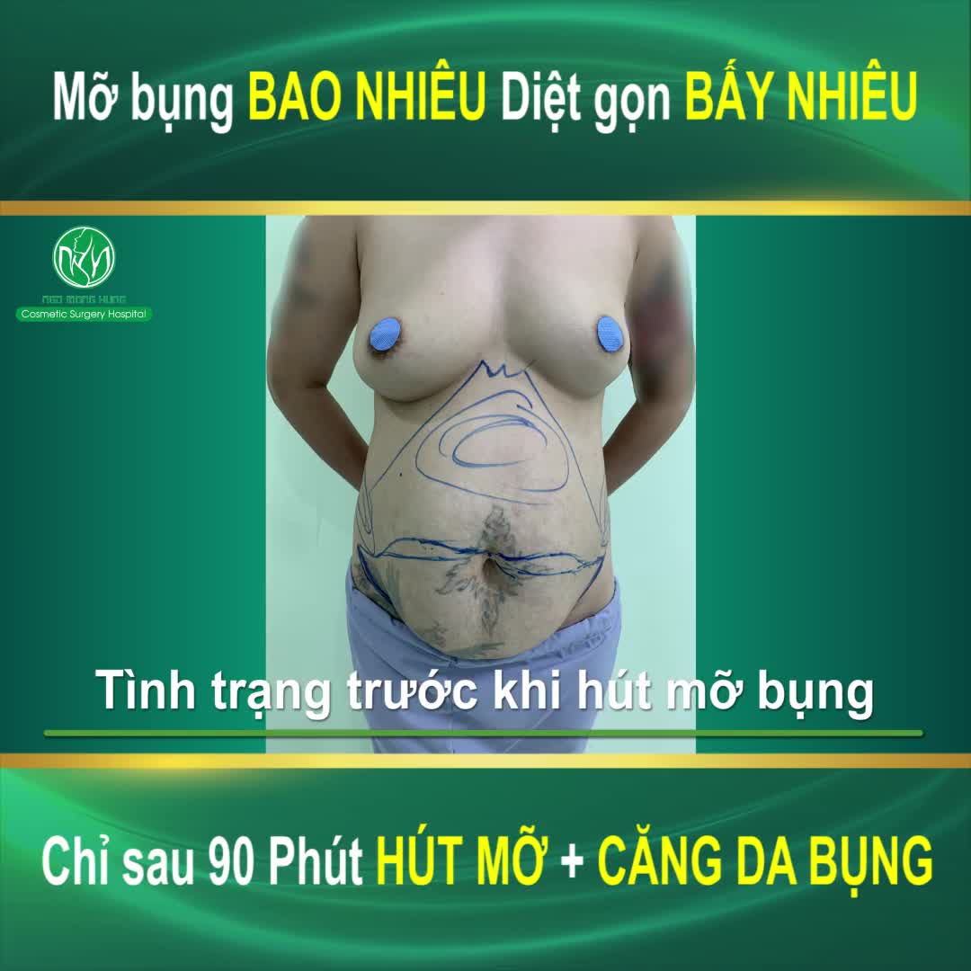 HOT HOT CÔNG BỐ Toàn Bộ Quá Trình Hút Mỡ Bụng + Căng Da Bụng