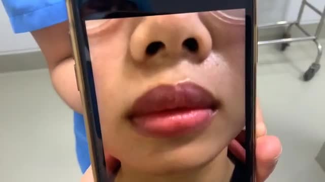 TẠO HÌNH MÔI với Dr VƯƠNG