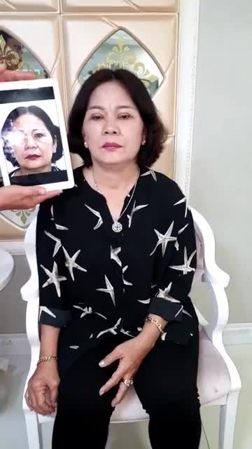 Kết quả sau phẫu thuật căng da toàn phần sau 2 tháng phẫu thuật