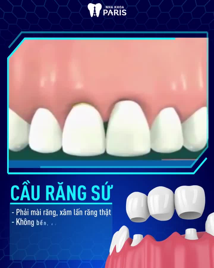 MẤT 1 RĂNG, NHIỀU RĂNG, TIÊU XƯƠNG HÀM