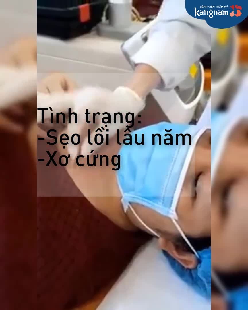 Sẹo lồi lâu năm phì to, xơ cứng, điều trị nhiều phương pháp không cải thiện