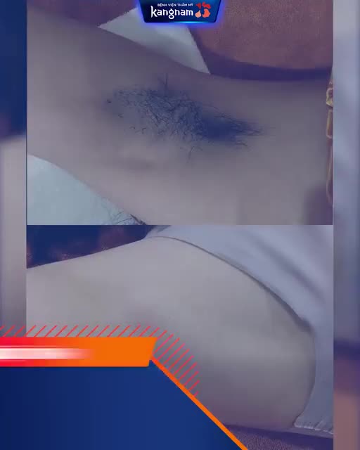 Vẫn là công nghệ TRIỆT LÔNG Diode Laser