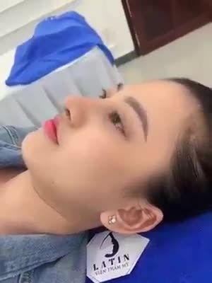Mũi cấu trúc Sụn Sườn sóng nâng bằng sụn surgiform sau 3 tuần
