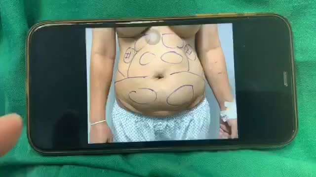 HÚT KIỆT MỠ với Dr Vương  NÊN KHÔNG NHẤT THIẾT PHẢI KẾT HỢP VỚI TẠO HÌNH THÀNH BỤNG
