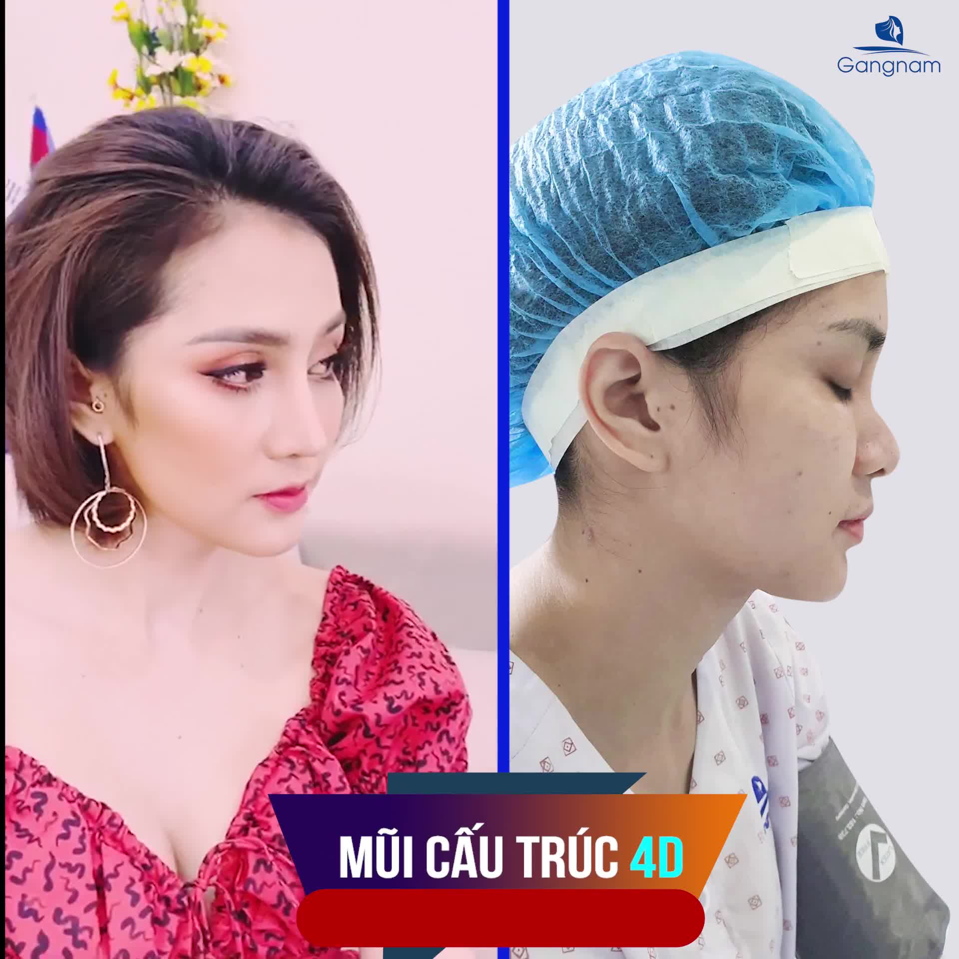 NÂNG MŨI CẤU TRÚC 4D NGƯỜI THỰC VIỆC THỰC