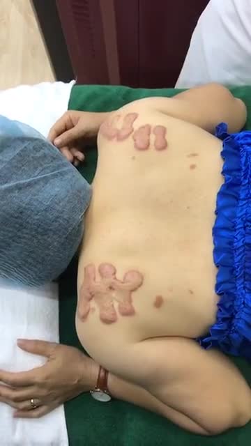 Điều trị sẹo lồi ở bả vai "cực lớn" tại Đông Á