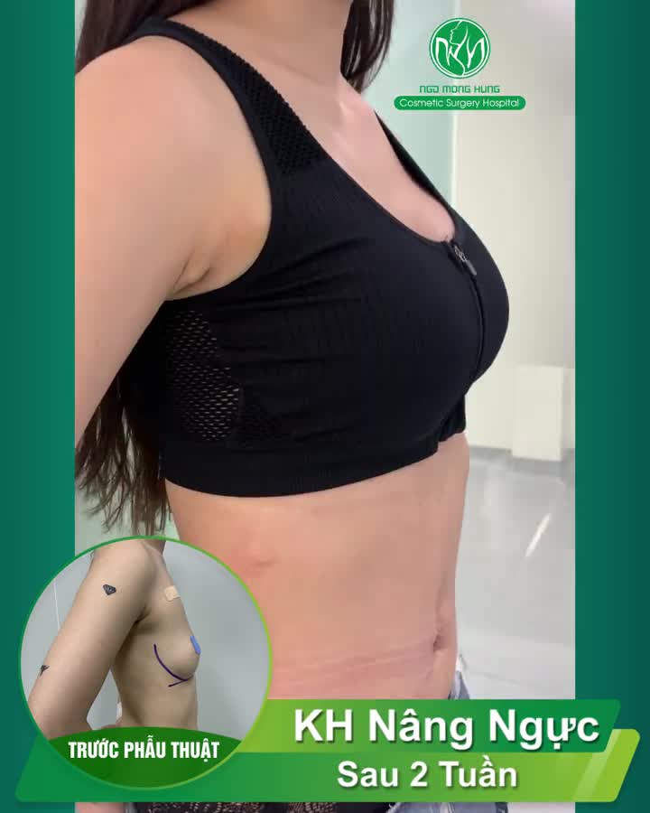 Chị khách quay lại bệnh viện sau 2 tuần Nâng Ngực Nội Soi.