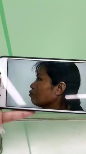 Kết quả sau phẫu thuật hô hai hàm