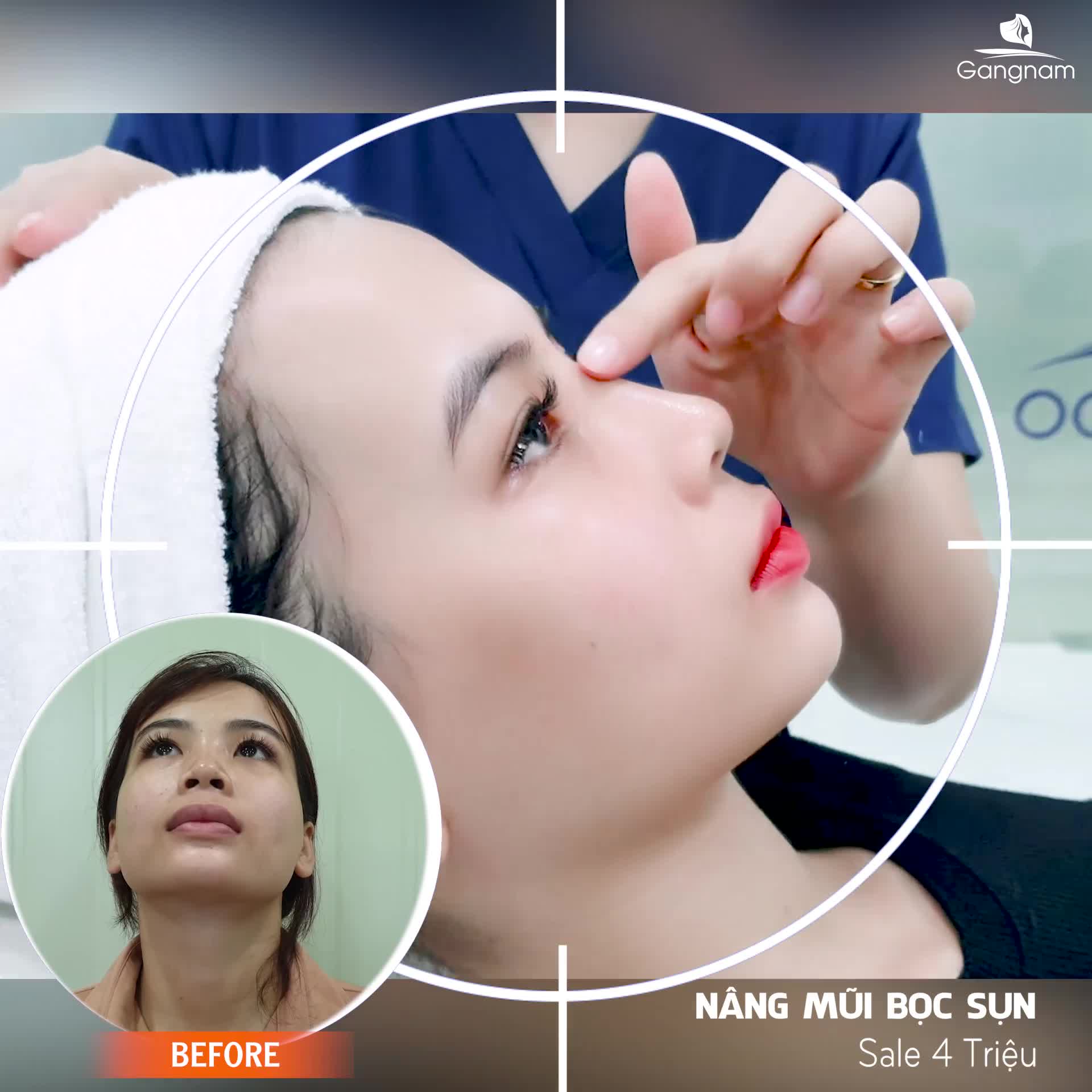 NÂNG MŨI BỌC SỤN TAI – KHẮC TINH MŨI BÓNG ĐỎ LỘ SÓNG