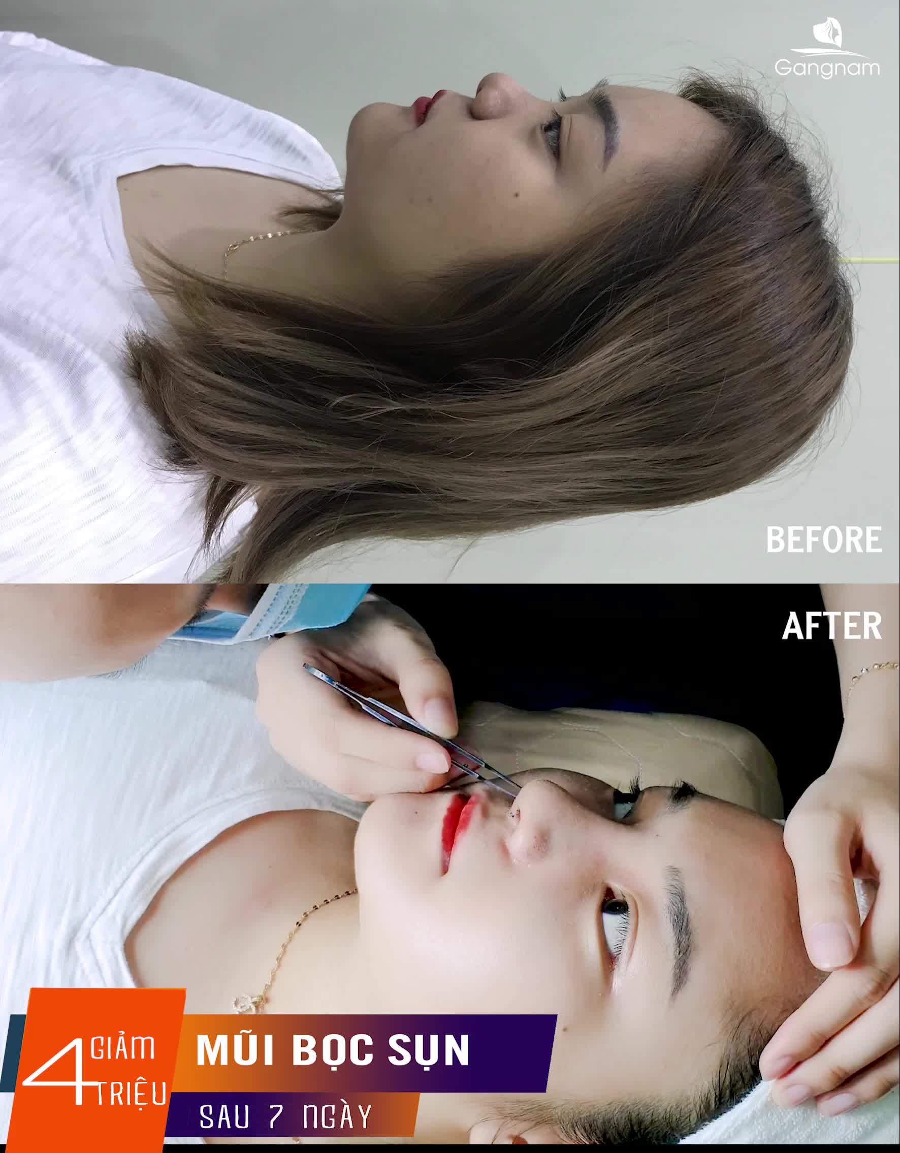 NÂNG MŨI BỌC SỤN TỰ THÂN CÓ MẮC KHÔNG?