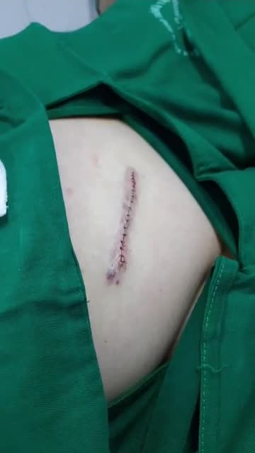 Phẩu thuật cắt sẹo lồi sau 1 năm dài 10cm. Vết khâu thẩm mỹ rất đẹp