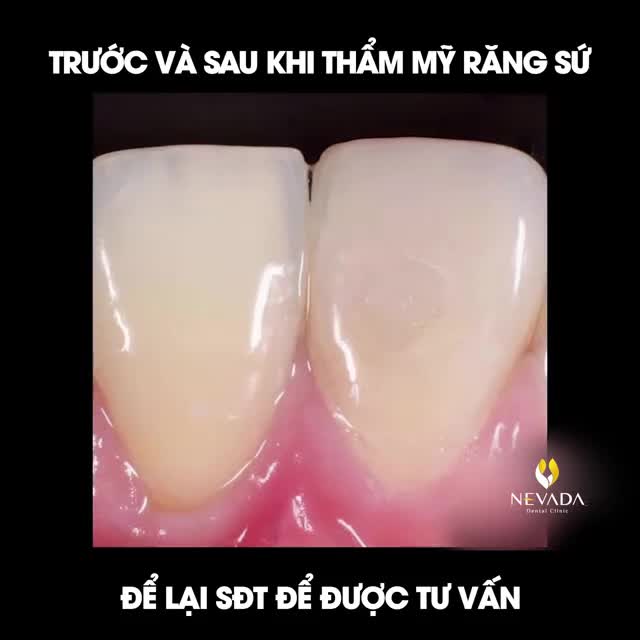 Xem thêm 109 video Bọc Răng Sứ của bác sĩ Bs nha khoa Nevada
