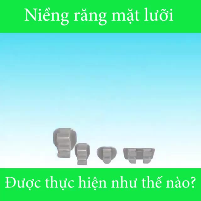 NIỀNG RĂNG MẶT LƯỠI ĐƯỢC THỰC HIỆN NHƯ THẾ NÀO