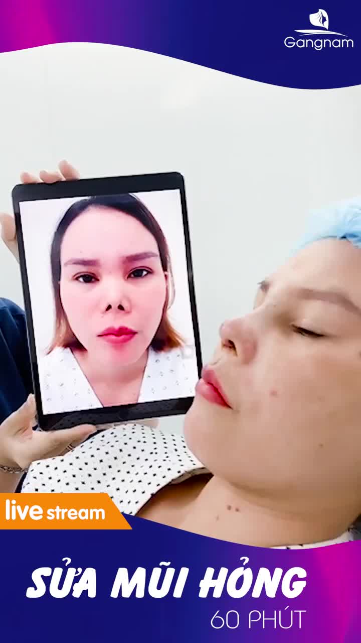 CHƯƠNG TRÌNH PHỤC HỒI MŨI BIẾN DẠNG CÙNG DR PARK