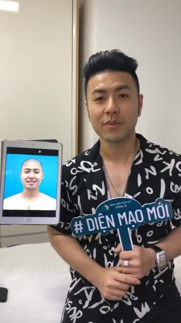 KẾT QUẢ CẤY TÓC sau 1 năm của ca sĩ Akira Phan