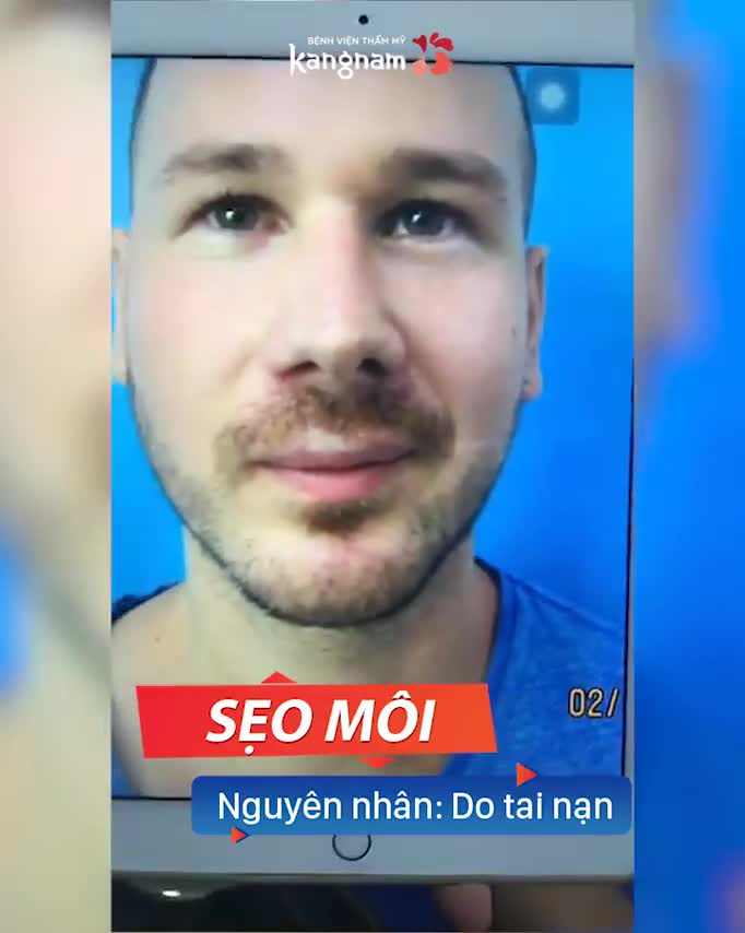 Khách hàng SỬA SẸO MÔI - TẠO HÌNH MÔI - Hóa Nam Thần