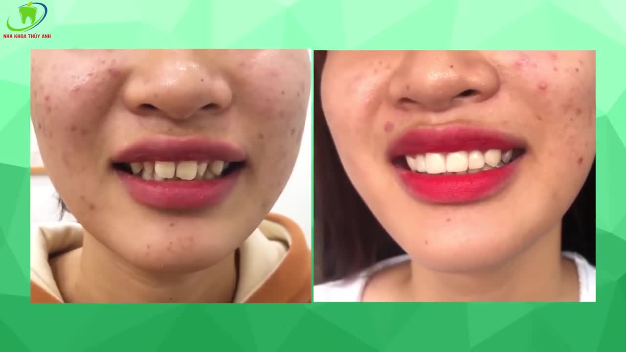 THAY ÁO MỚI CHO RĂNG - THĂNG HẠNG NỤ CƯỜI