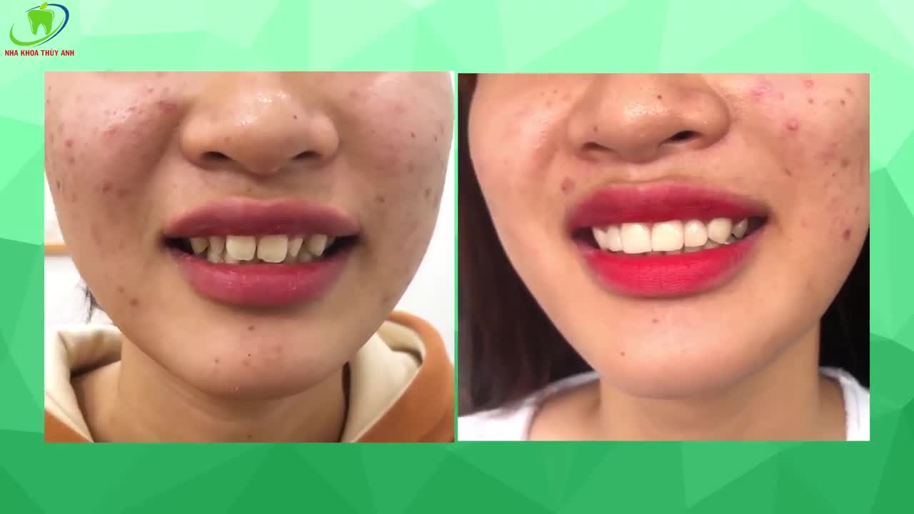 RĂNG CÓ ĐẸP THÌ CƯỜI MỚI TỰ TIN