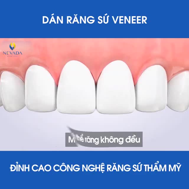 Xem thêm 16 video Mặt Dán Sứ Veneer của bác sĩ Bs nha khoa Nevada