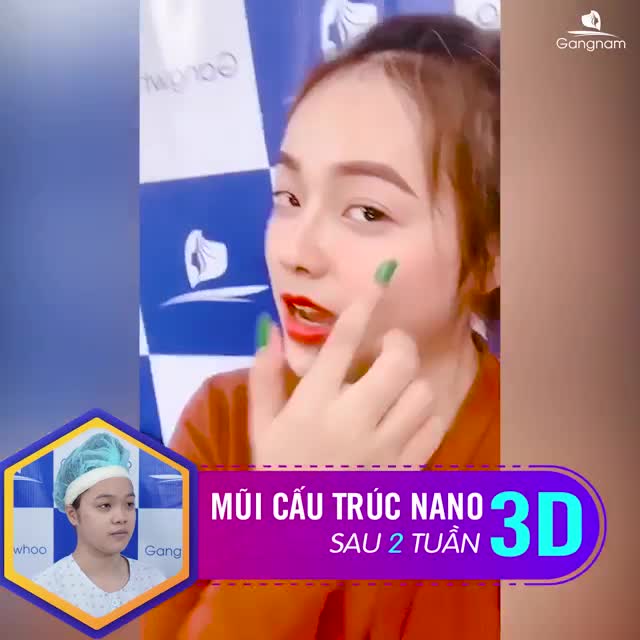 Đây là kết quả sau 2 tuần nâng mũi cấu trúc nano form từ nhà bác sĩ Park.