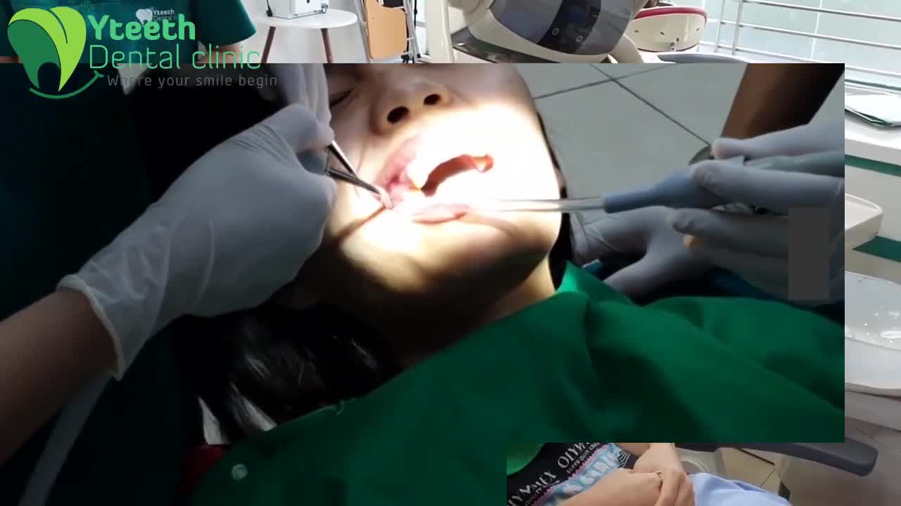 So với mắc cài kim loại, mắc cài sứ đắt hơn từ 7-10 triệu nhưng lại đem đến cho người niềng răng diện mạo tự tin hơn hẳn.
