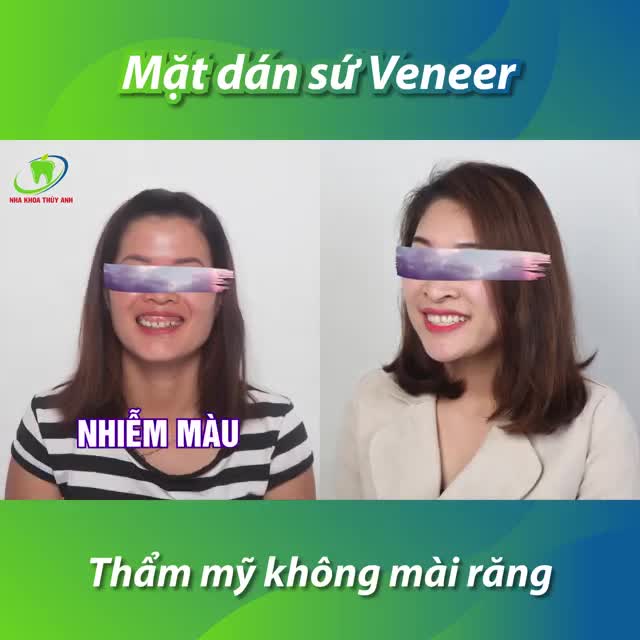 MẶT DÁN SỨ VENEER - GIẢI PHÁP THẨM MỸ RĂNG KHÔNG MÀI RĂNG