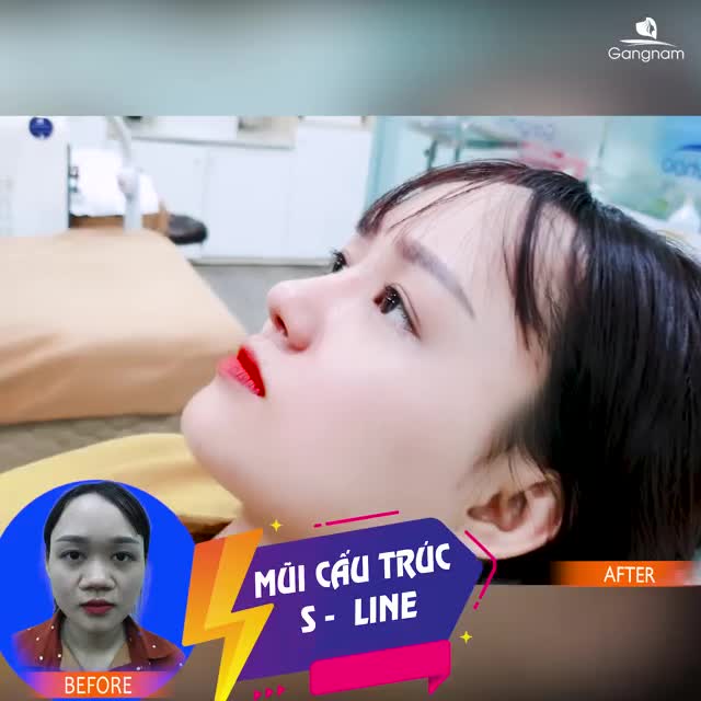 NÂNG MŨI - CÓ ĐÁNG SỢ NHƯ BẠN NGHĨ