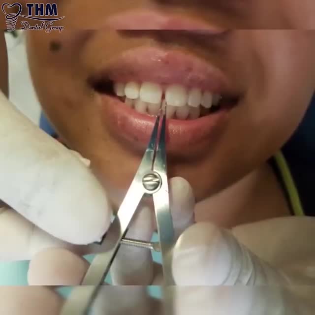 TRÁM KHE HỞ RĂNG CỬA - PHỤC HỒI NỤ CƯỜI TỰ TIN CHO BẠN