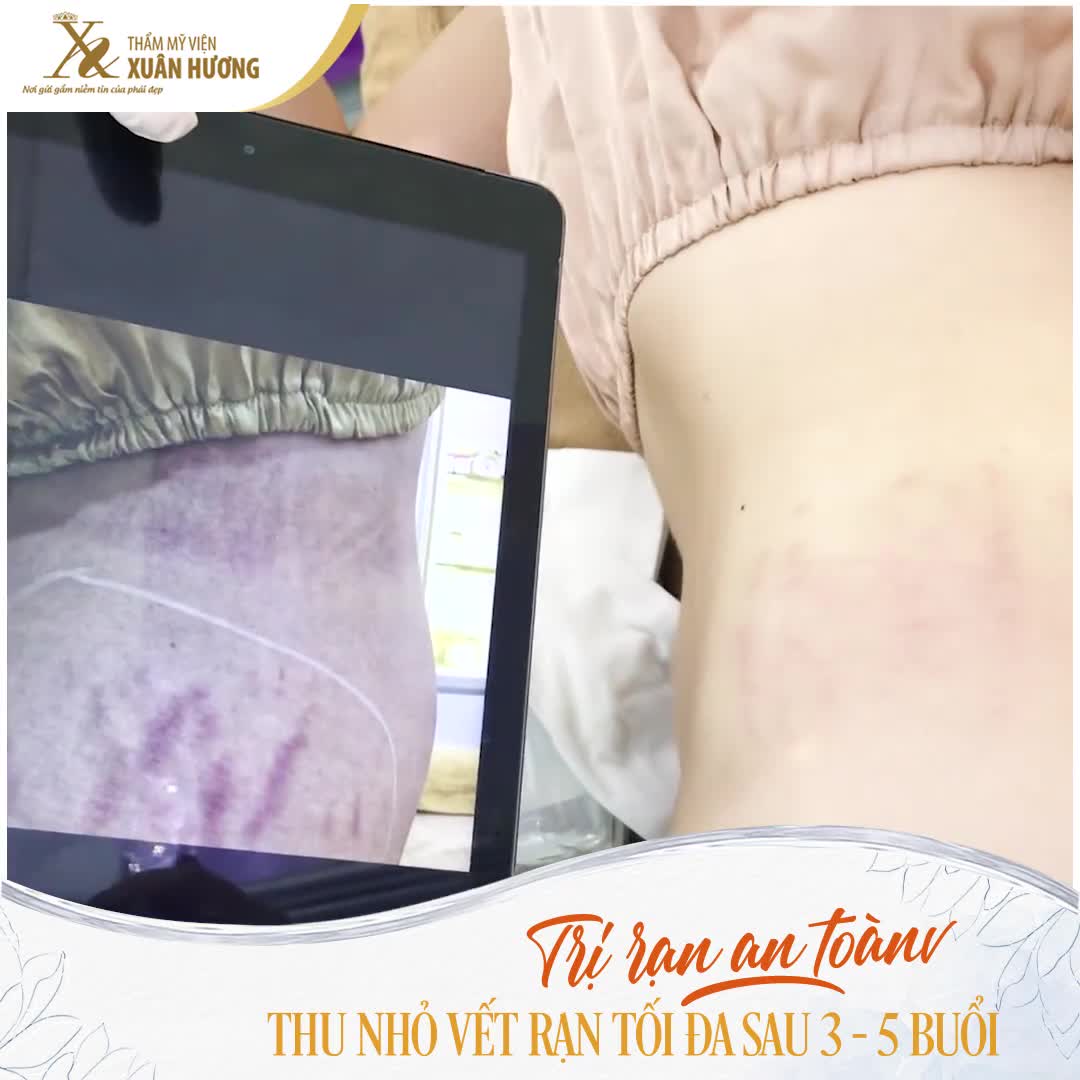 RẠN DA CHẲNG CHỊT KHÔNG LỐI THOÁT, ĐIỀU TRỊ TẠI XUÂN HƯƠNG SỞ HỮU DA CĂNG MỊN NHƯ THỜI THIẾU NỮ