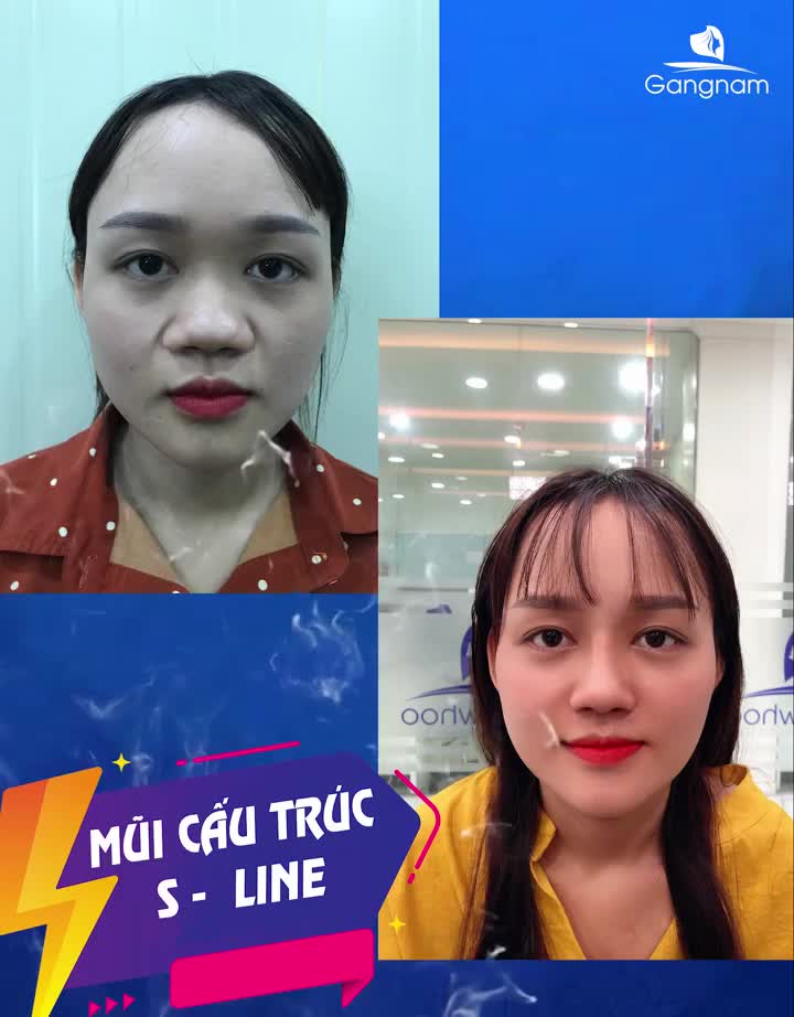 NÂNG MŨI CẤU TRÚC VÌ SAO HOT?