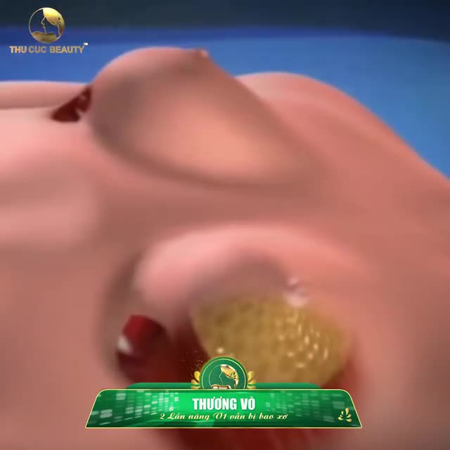 V1 BAO XƠ SAU 2 LẦN THẨM MỸ HỎNG - THÁNH COVER THƯƠNG VÕ ĐÃ TÌM LẠI V1 HOÀN HẢO TẠI THU CÚC