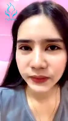 NÂNG MŨI CAO TÂY CẮT MÍ HÀN QUỐC FEEDBACK SAU 15 NGÀY ĐẸP HÚT HỒN