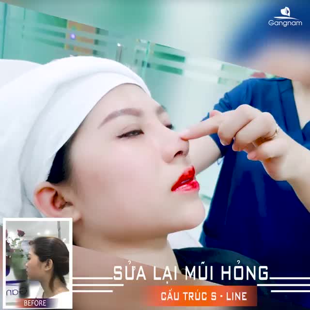 VÌ SAO NÊN CÂN NHẮC THẬT KỸ TRƯỚC KHI NÂNG MŨI?