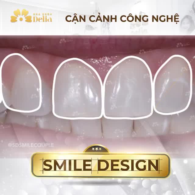 CÔNG NGHỆ THIẾT KẾ NỤ CƯỜI SMILE DESIGN - TÁI TẠO NỤ CƯỜI CHO RIÊNG BẠN!