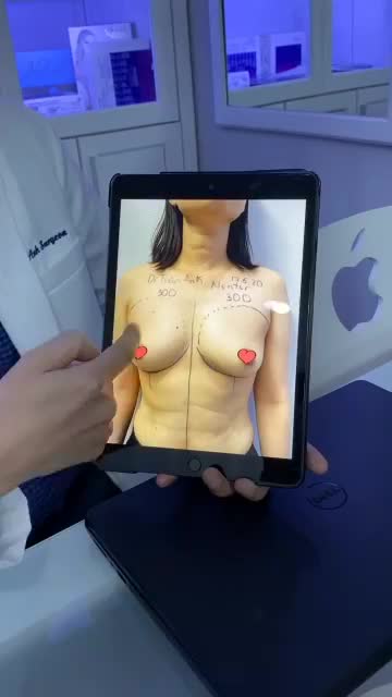 NÂNG NGỰC SAU BAO LÂU THÌ ỔN ĐỊNH VÀ "LÊN DÁNG" TỰ NHIÊN?