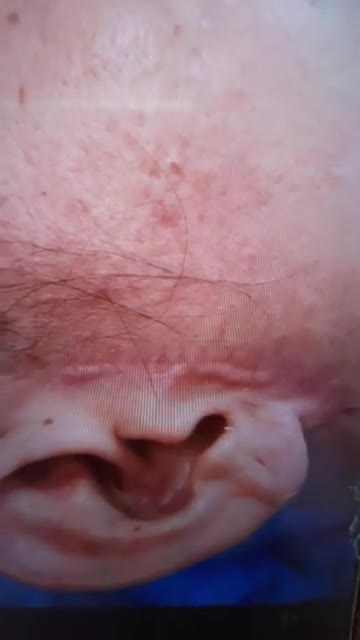 Khách hàng CẮT SẸO THẨM MỸ sau căng da mặt ở cơ sở khác