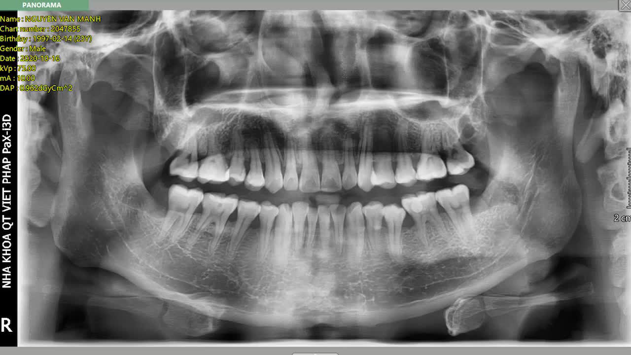 NHỔ CẶP RĂNG 8 + CẤY TẾ BÀO GỐC