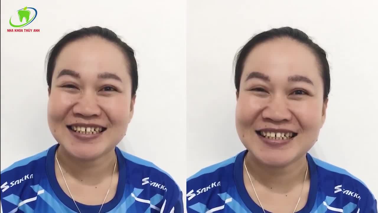 NỤ CƯỜI TRỌN VẸN HƠN VỚI MẶT DÁN SỨ MỎNG - BỀN - ĐẸP