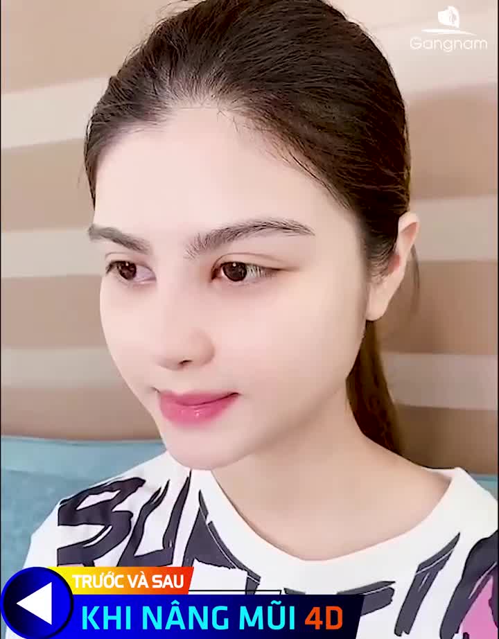 NÂNG MŨI BỌC SỤN NHÀ DR PARK!!