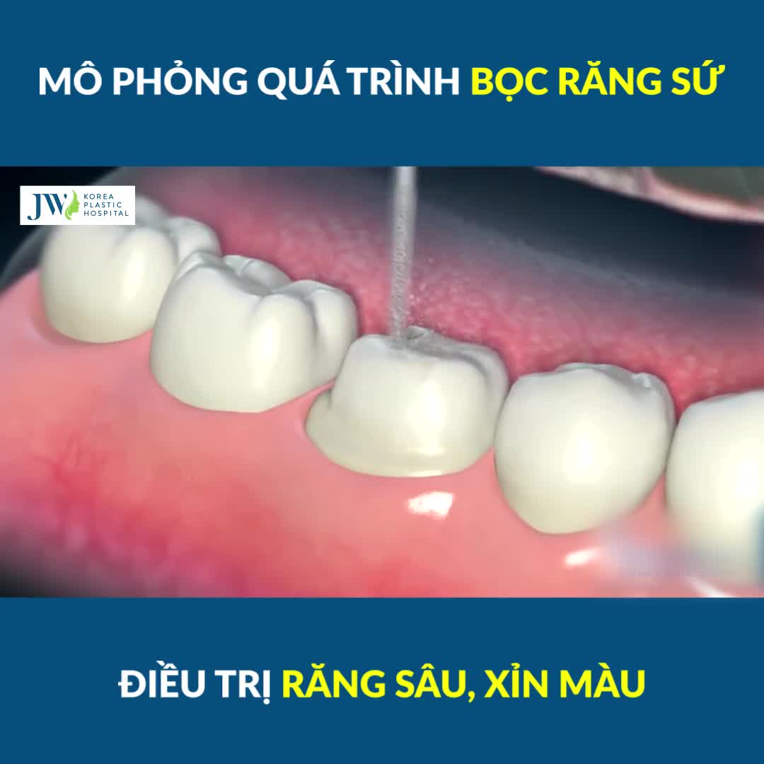 CẬN CẢNH QUÁ TRÌNH BỌC RĂNG SỨ