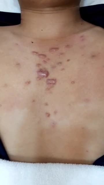 Sẹo lồi chi chít, sẹo thâm lâu năm