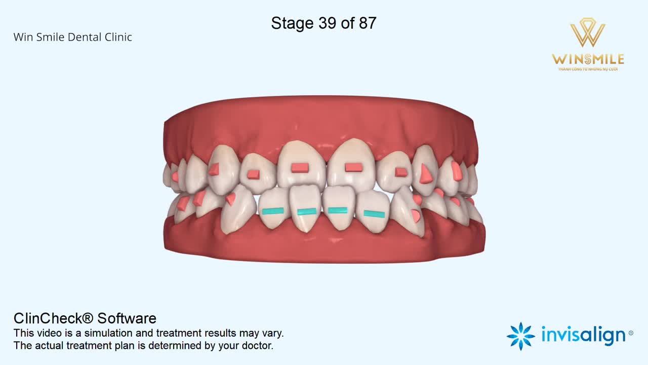 KHỚP CẮN HỞ CÓ LÀM KHÓ ĐƯỢC INVISALIGN
