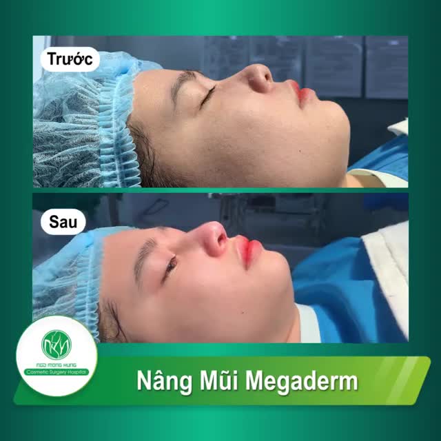 CA NGỰC KHỞI ĐỘNG SÁNG THỨ 2