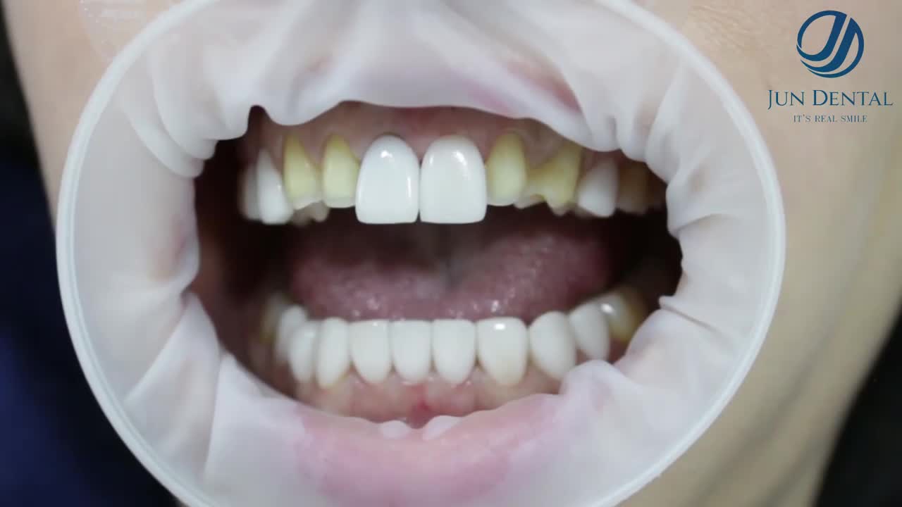 Cận cảnh quy trình Dán sứ tại Jun Dental
