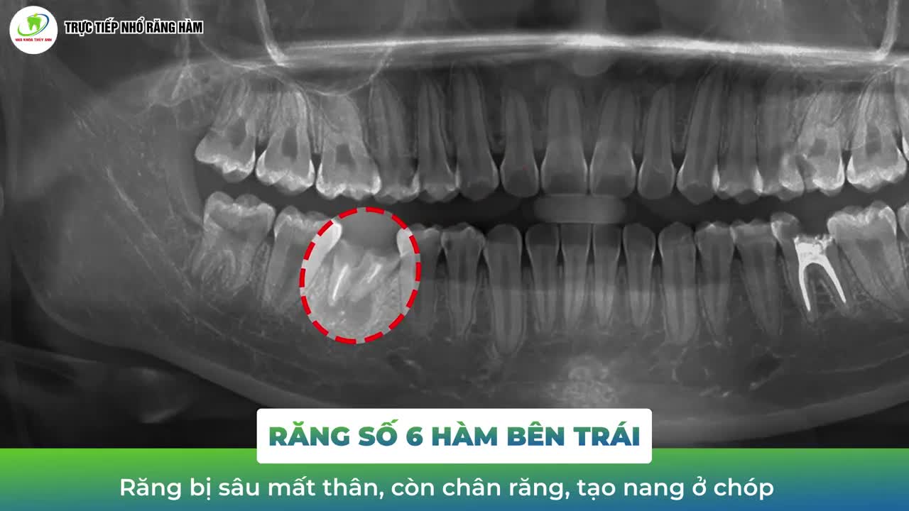 QUY TRÌNH NHỔ RĂNG SỐ 6 HỎNG CHỈ CÒN CHÂN RĂNG.