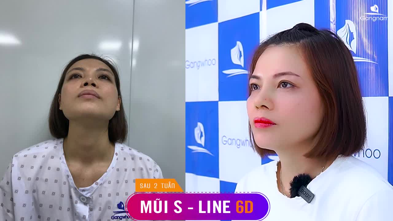 NÂNG MŨI BAO LÂU THÌ ĐƯỢC NẰM NGHIÊNG?