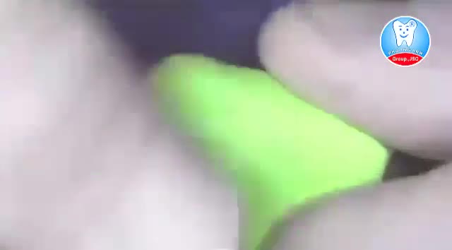 Răng bi thưa thì làm như thế nào