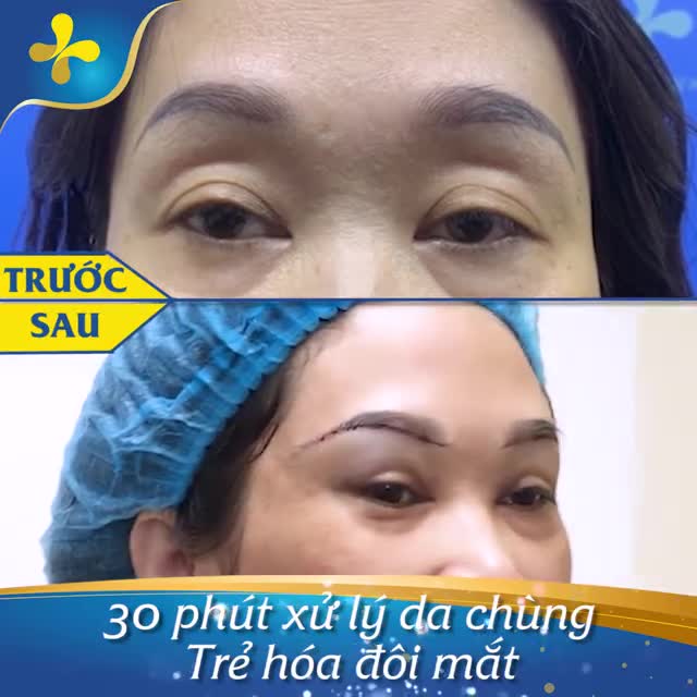 Chiêm ngưỡng kết quả sau 30 phút Treo cung mày Tạm biệt da chùng, mí sụp Giải pháp tối ưu giúp trẻ hóa đôi mắt cho chị khách hàng U46.