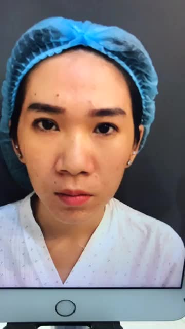Livestream ca tiêm mỡ full vùng mặt vừa hoàn thành tại phòng phẫu thuật